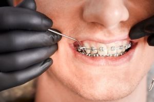 Orthodontist placing rubber bands on male patient braces Orthodontist placing rubber bands on male patient braces