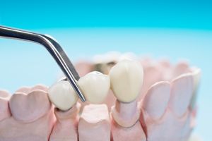 Dental Bridges Closeup / prosthodontics or prosthetic / teeth crown and bridge implant dentistry equipment and model express fix restoration.