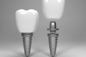 Dental implants surgery 3d rendering