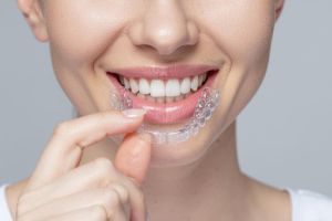 Woman with invisalign aligners showing a perfect smile